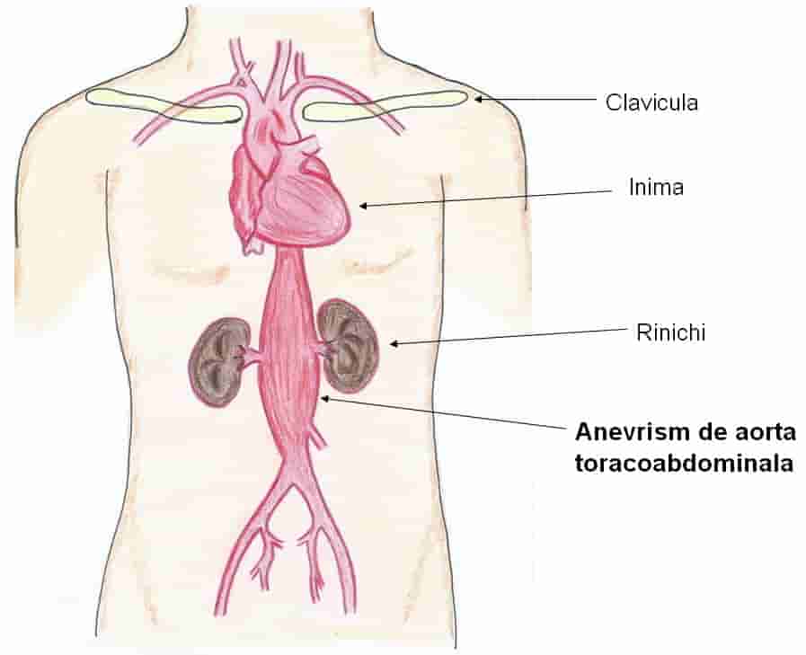 anevrism de aorta toracoabdominala