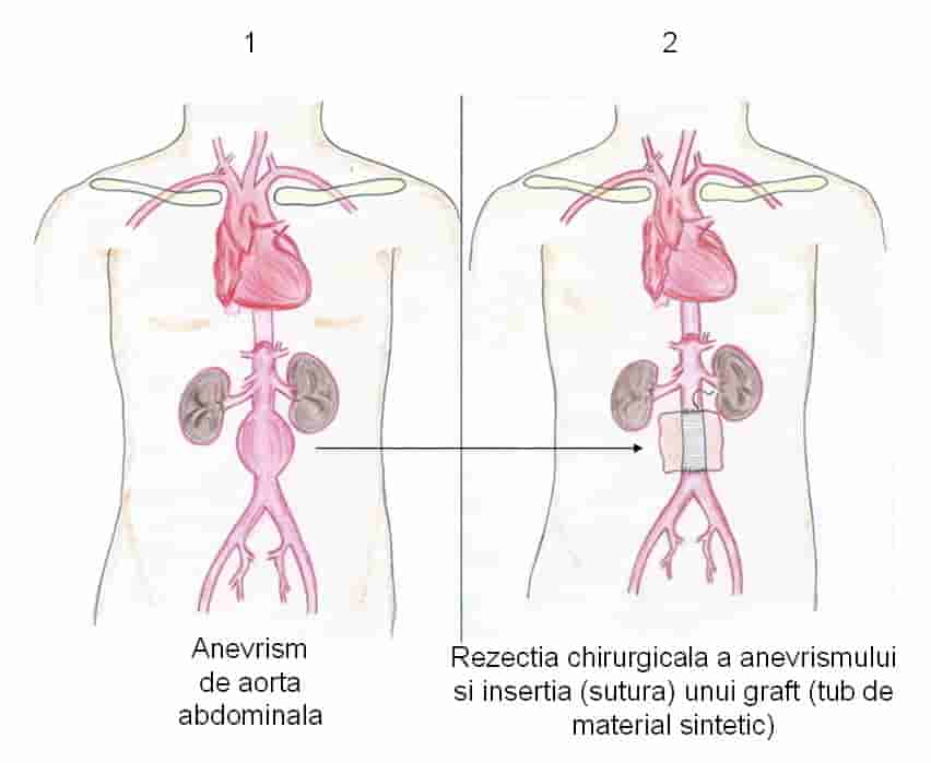 tratamentul chirurgical al anevrismului de aorta