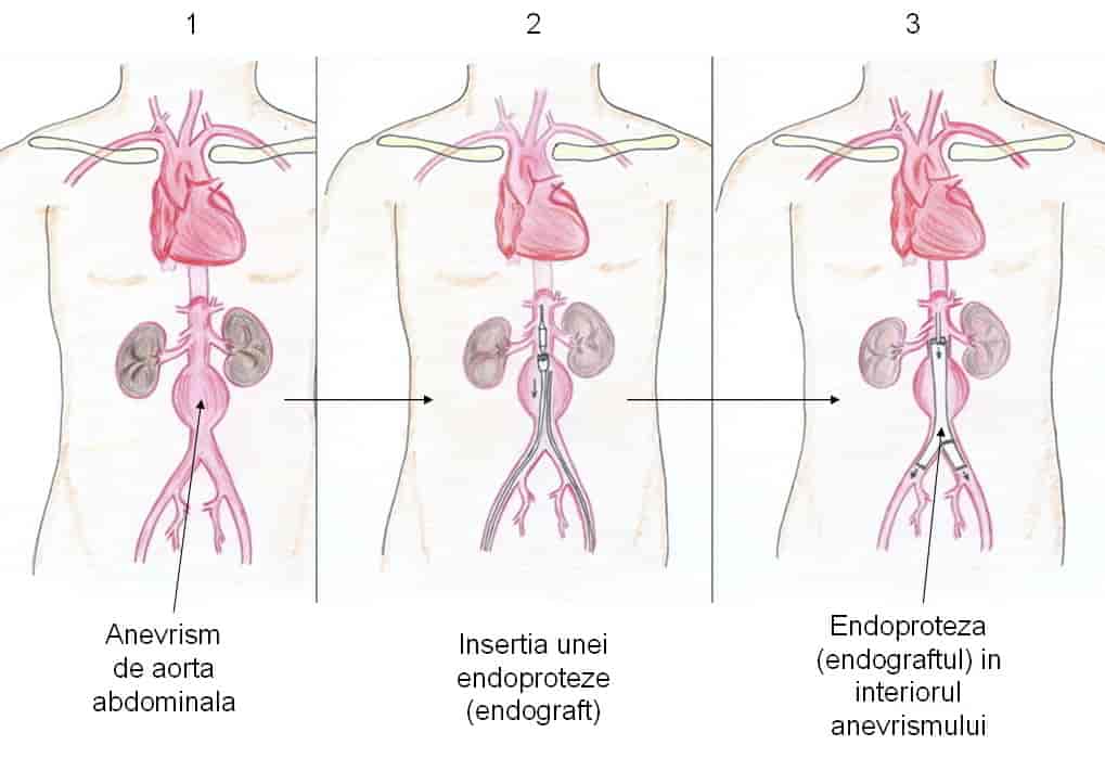 tratamentul endovascular al anevrismului de aorta